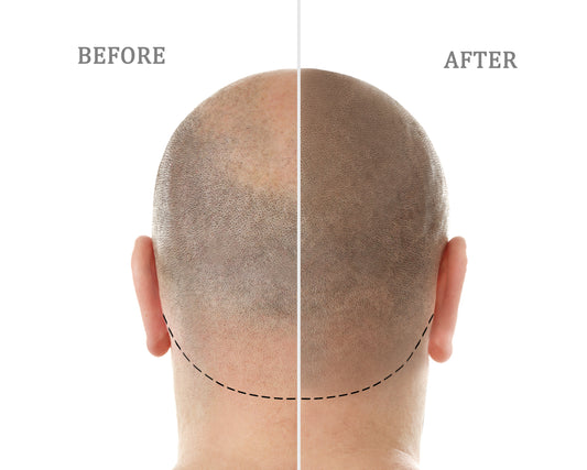 Scalp Micropigmentation