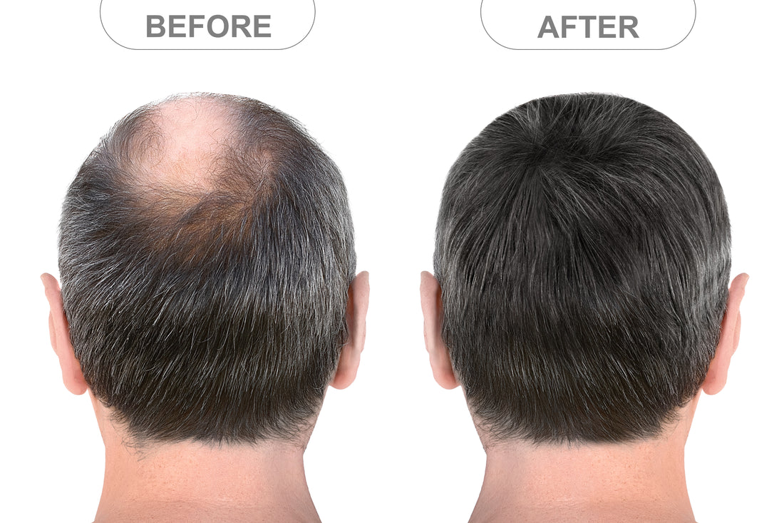 Men's Hair Replacement Systems
